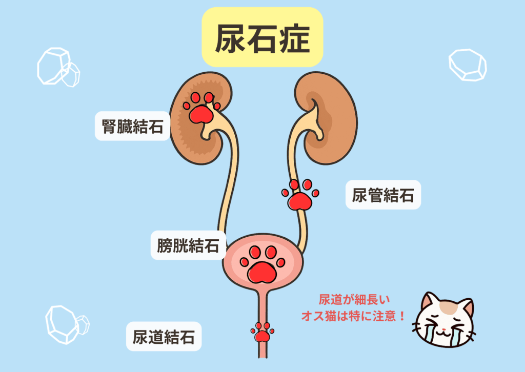 「石ができる場所と名称」泌尿器の図解：左右に腎臓があり、それをつなぐ膀胱、その下にある尿道にできる